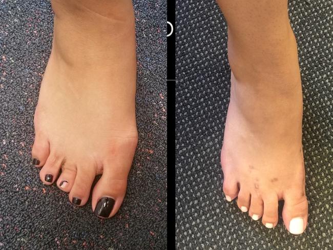 Toe lengthening and shortening procedures are also on the rise. Picture: Supplied by Sydney Foot Surgery