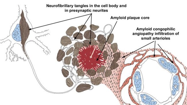 Amyloid plaque that gathers in the brain destroys cells in Alzheimer’s patients