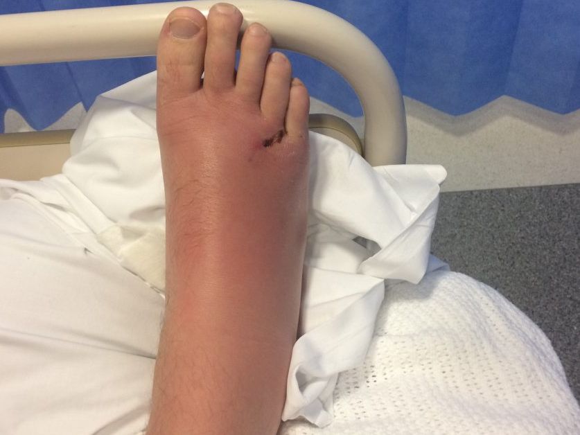 UPDATE: Man awaiting surgery after stepping on stingray barb