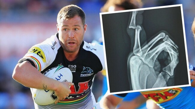 Trent Merrin's very broken finger.
