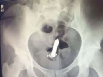 Woman loses vibrator in her bum and needs surgery to remove it. Picture: TikTok