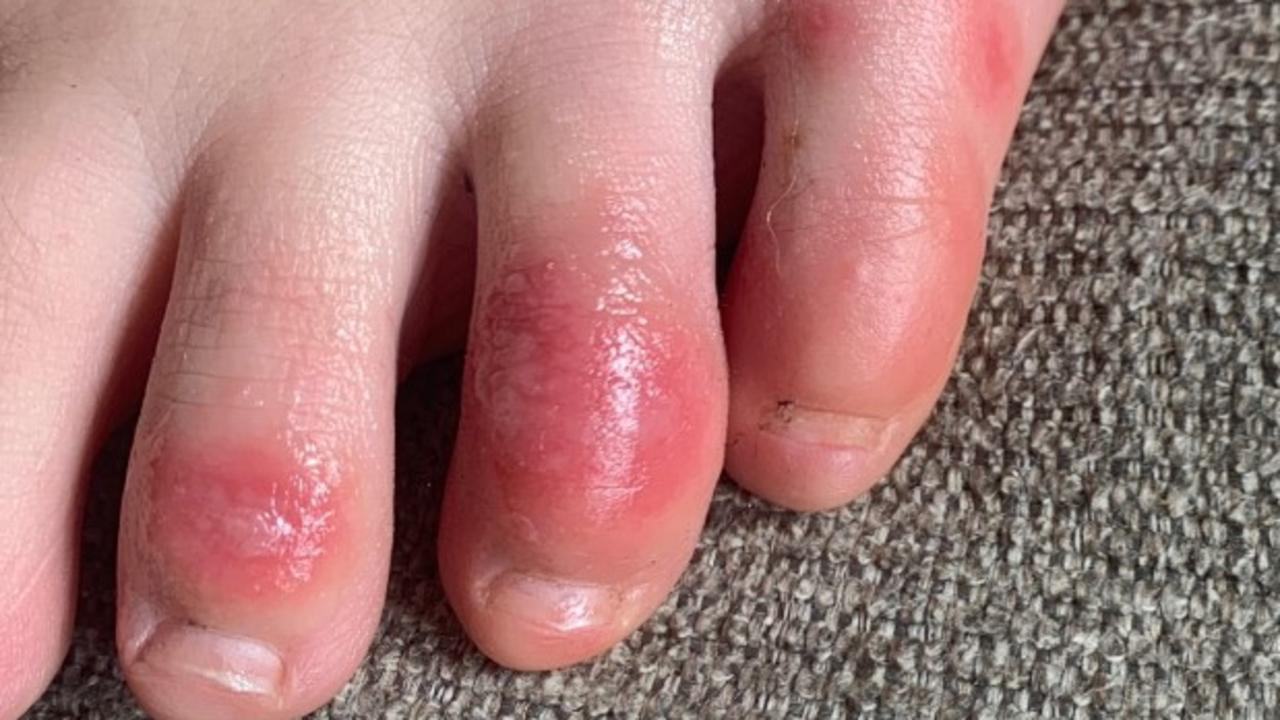 coronavirus-covid-toes-among-unusual-symptoms-of-infection-news