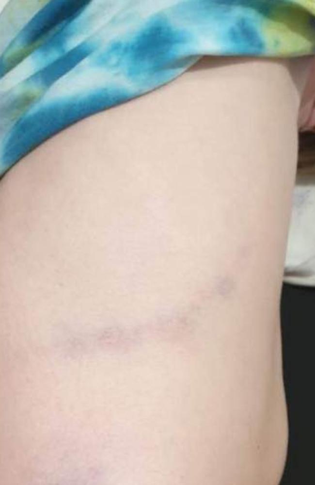 A bruise on a student allegedly sustained during a violent encounter at Yarrabilba State School. Picture: Supplied