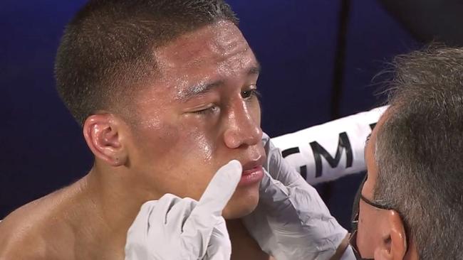 Joshua Franco’s right eye closed over forcing the fight to be stopped.