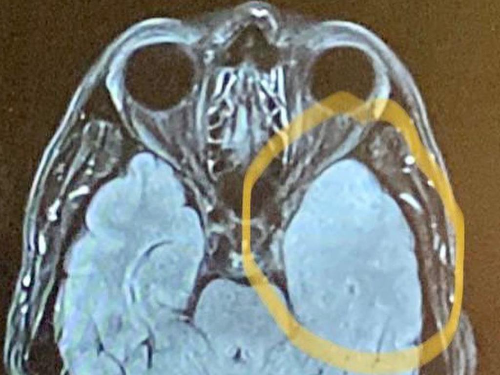 An MRI scan showed a tumour on the 56-year-old’s brain. Picture: Instagram@profrscolyer