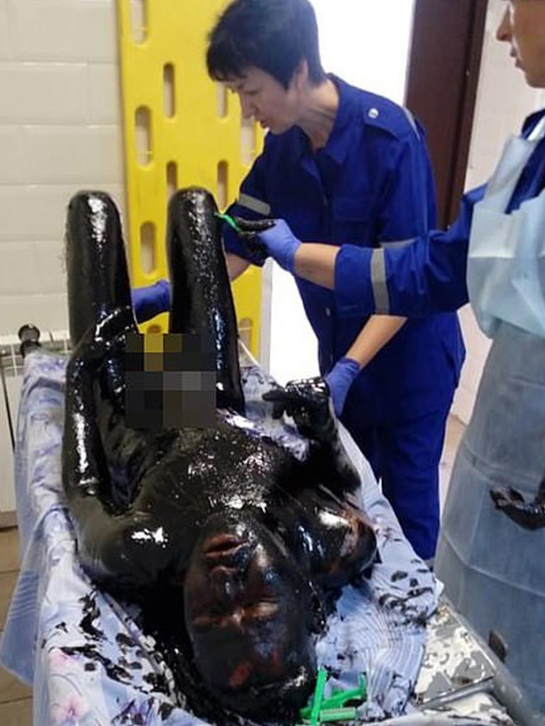 Medics took several hours to scrape off the tar from every inch of the man’s body. Picture: VK