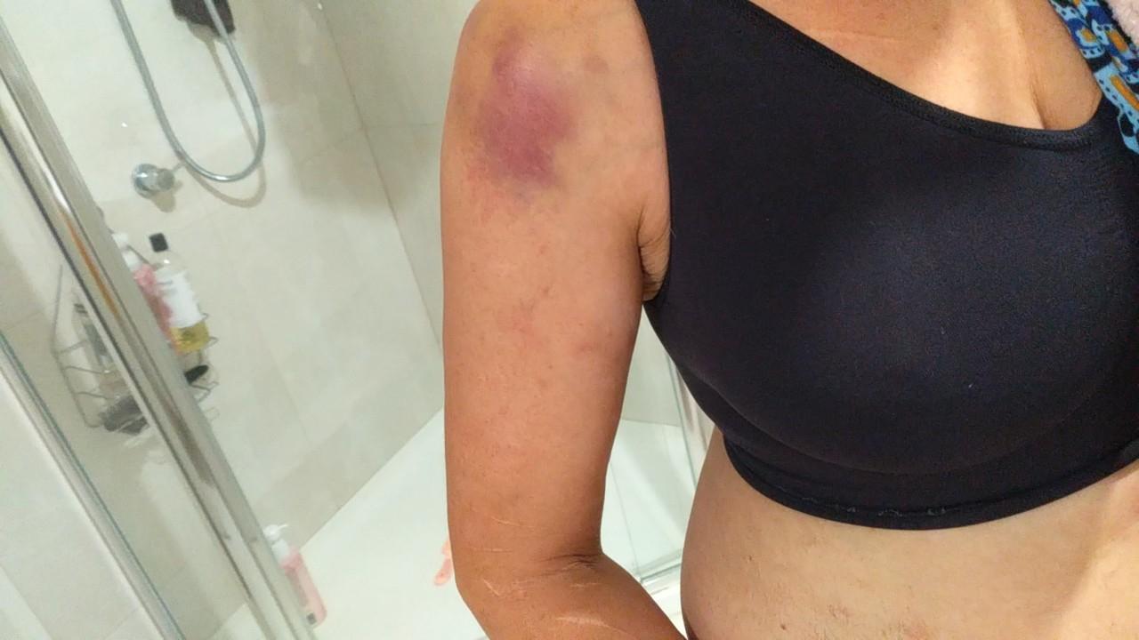 Injuries sustained by West Launceston woman Crystal Aldridge, 44, during a mistaken arrest by Tasmania Police officers at her unit on April 7, 2022. Picture: Supplied