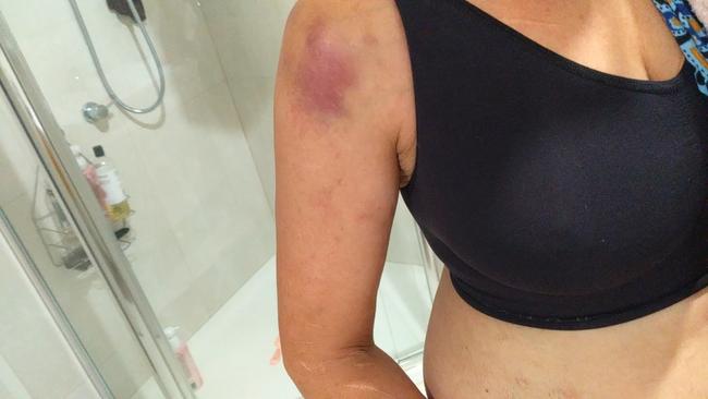 Injuries sustained by West Launceston woman Crystal Aldridge, 44, during a mistaken arrest by Tasmania Police officers at her unit on April 7, 2022. Picture: Supplied