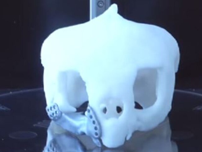 New technology ... The prosthetic was built inside a 3D printer. Picture: BTech Innovation