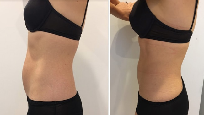 Fat freezing work for belly fat? An honest review on the side effects, cost  and pain