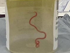 It's the world's first known case of a roundworm from a carpet python infecting a human. Picture: ANU