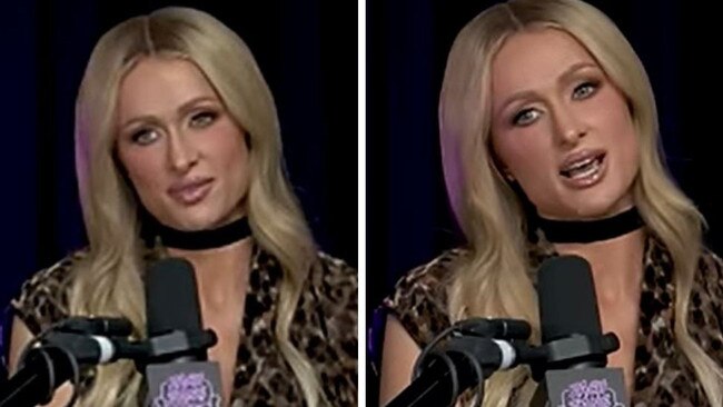 Paris Hilton calims she's never has surgery or Botox.