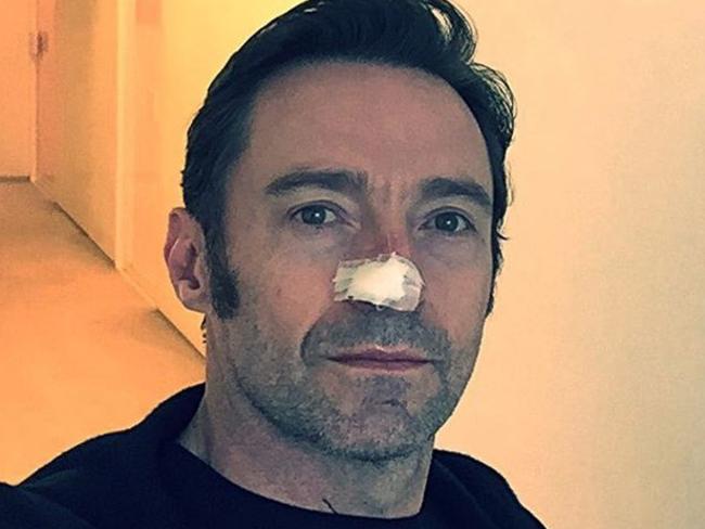 Hugh Jackman posted on Instagram. “Another basal cell carcinoma. Thanks to frequent body checks and amazing doctors, all is well. Looks worse with the dressing on than off. I swear! #wearsunscreen"