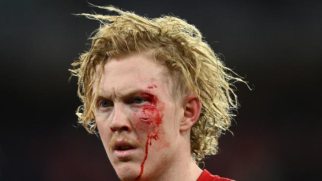 A wounded Clayton Oliver walks off the field with a cut eye after coming up short against the Sydney Swans.