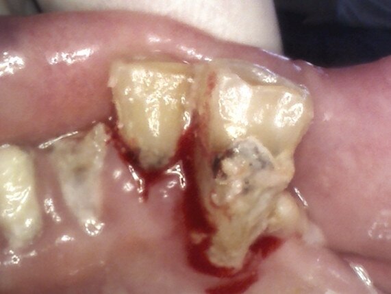 An 88-year-old female had not had teeth cleaned under partial denture for five months. Picture: Supplied