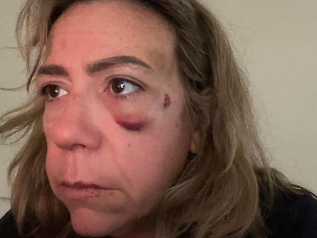 Caitlin Morrison, 45, was assaulted on a Melbourne tram on April 22. Picture: Supplied
