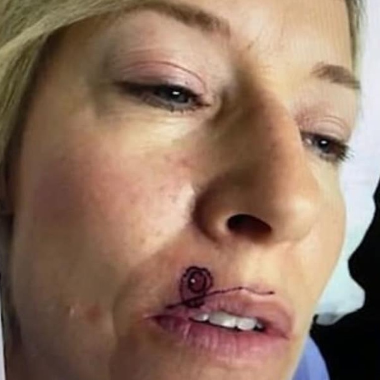 Tracy French, from Arcadia in Canada, spotted a ‘pimple’ on her upper lip a few years ago but never thought anything of it. Picture: KABC 7