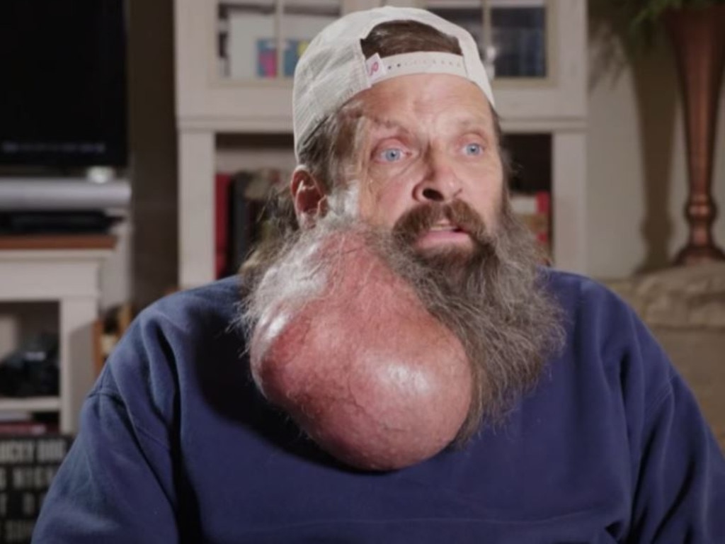 Tim, 62, had a watermelon sized tumour growing out of his face, which swelled in size over 16 sixteen years. Picture: YouTube/TLC