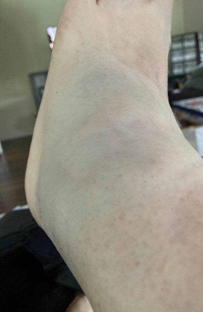 Liz Costello’s swollen, fractured ankle.