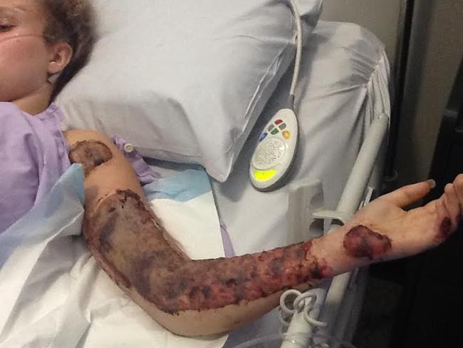 Madeleine needed skin grafts for her arm which received third degree burns.