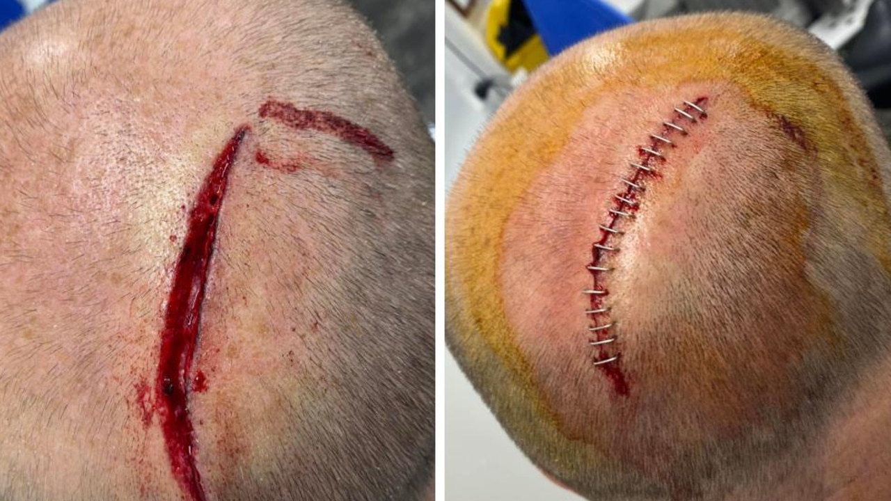 Derek Symons had 16 staples in the back of his head after a surfing incident at Noosa Heads.