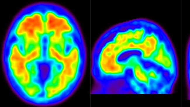 PET brain scan showing amyloid plaque in the brain of a person with Alzheimer's disease