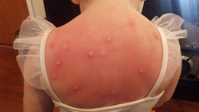 Other parents shared photos of their children’s bites. Photo: Facebook