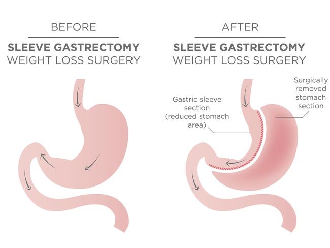 The operation is called the sleeve gastrectomy and works by reducing the size of the stomach.
