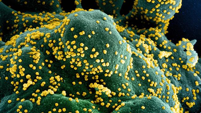 A colorised scanning electron micrograph of an apoptotic cell (blue/green) heavily infected with SARS-COV-2 virus particles (yellow), isolated from a patient sample, captured at the NIAID Integrated Research Facility (IRF) in Fort Detrick, Maryland. Picture: National Institute of Allergy and Infectious Diseases/AFP