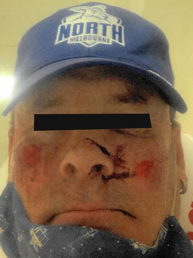 The victim of Andrew Martini’s assault. Martini has pleaded guilty to intentionally causing injury. Pictures: supplied