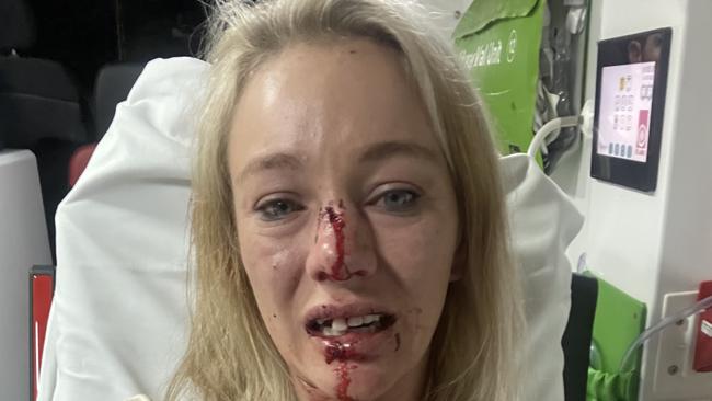 Jockey Sonja Logan’s injured after being bashed by a group of men last year. Picture: Supplied.