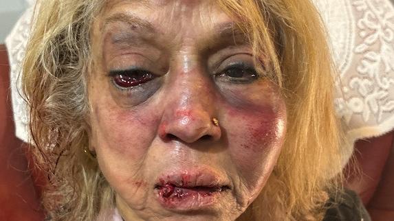 Ninette  Simons received severe facial bruising and swelling after she was  assaulted during a shocking home invasion at her Girrawheen home earlier this month.  Credit: WA Police/Supplied