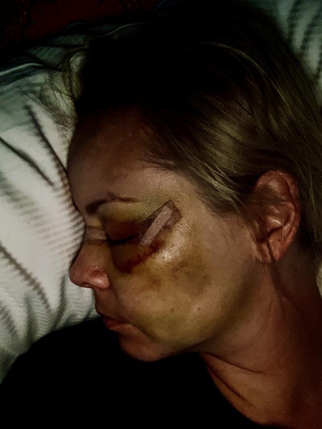 Ms O'Reilly was bashed by former boyfriend Jake Frecker. Picture: Supplied