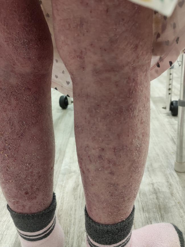 Whistleblower images of another patient with a rash alleged to be scabies. Picture: Supplied