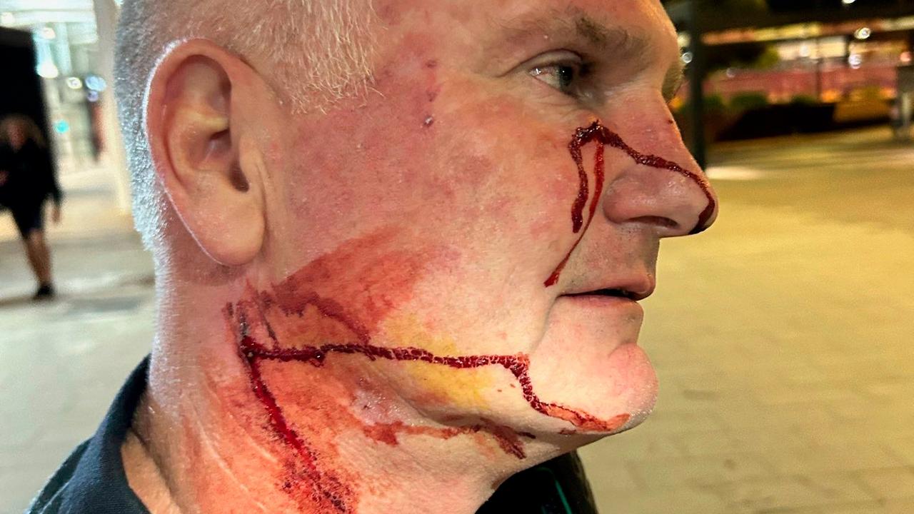 Pen-inflicted injuries to an AFP officer at Perth Airport. Picture: AFP