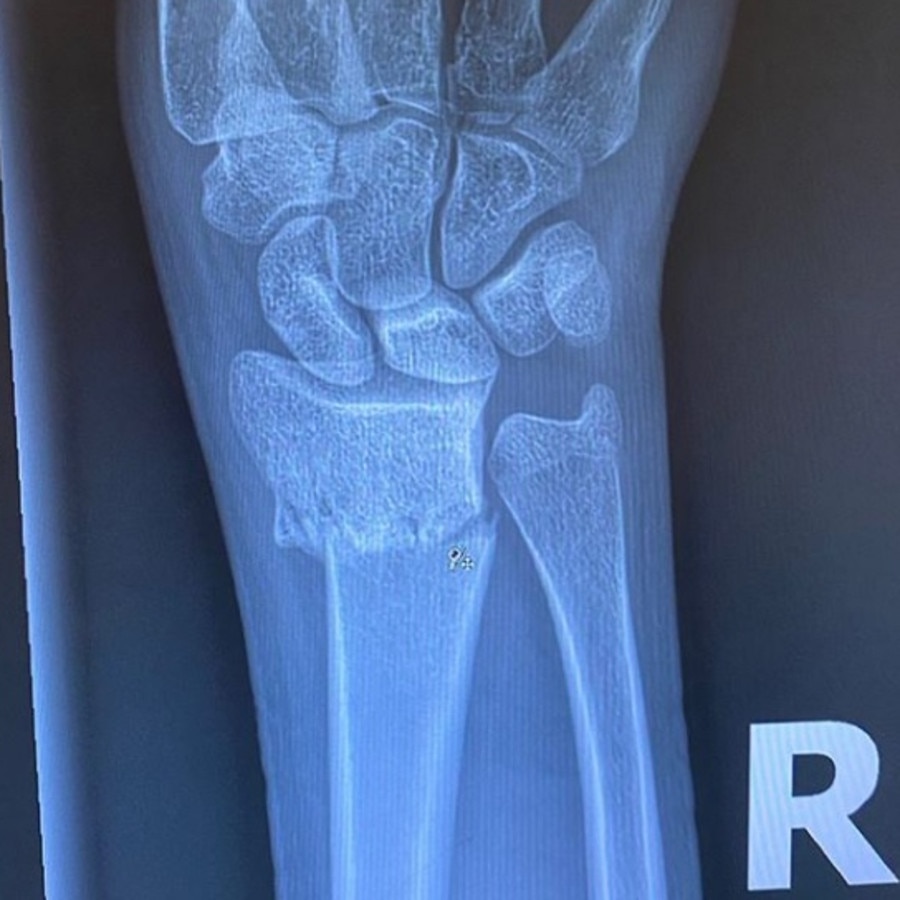 Another image showed an X-ray of a broken bone. Kaia Gerber reveals she broke her wrist. Picture: Instagram/KaiaGerber