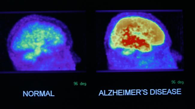 A scan of a healthy brain versus one with Alzheimer’s disease.