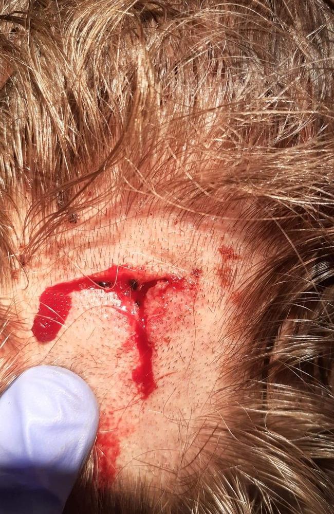 Jennie Copley submitted photos of the injury to her husband's head after she says people broke into her Rosebery home in March 2022. Picture: Contributed