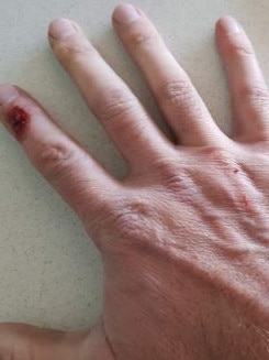 A hand injury to Alex Gardner.