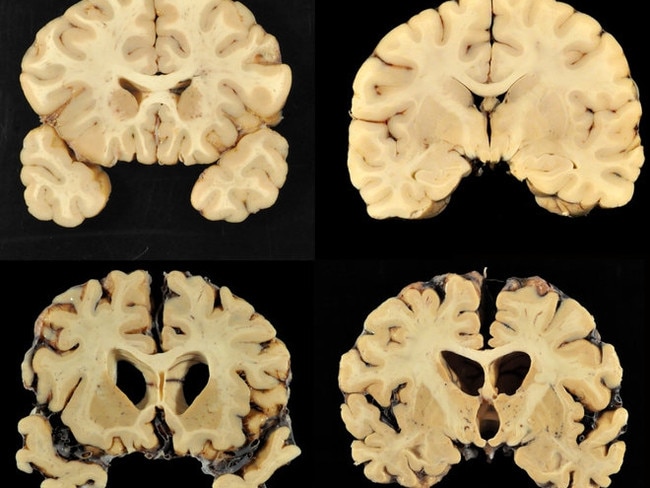 This combination of photos provided by Boston University shows sections from a normal brain, top, and from the brain of former University of Texas football player Greg Ploetz, bottom, in stage IV of chronic traumatic encephalopathy. According to a report released on Tuesday, July 25, 2017 by the Journal of the American Medical Association, research on the brains of 202 former football players has confirmed what many feared in life _ evidence of chronic traumatic encephalopathy, or CTE, a devastating disease in nearly all the samples, from athletes in the NFL, college and even high school. Picture:LiveScience