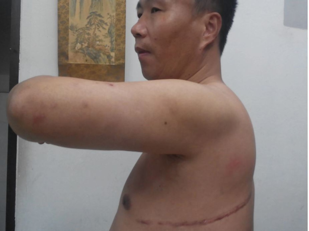 Cheng Pei Ming shows a huge scar he says was from forced surgery.