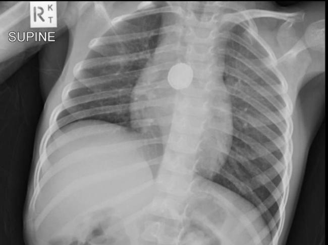 An X-ray shows the a button battery in her oesophagus.