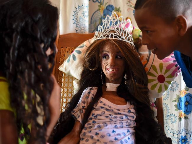 Colombian Magali Gonzalez Sierra (C), 15, speaks with her before her 15th birthday party in El Cabuyal, department of Valle del Cauca, Colombia, on January 16, 2016. Magali suffers from Hutchinson-Gilford progeria syndrome, a disease that causes premature aging in children, whose average lifespan is 13 years old. Picture: AFP PHOTO / LUIS ROBAYO