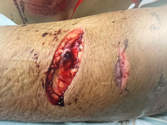 Injuries caused during a violent street fight allegedly involving members of the Brisbane Sikh Temple in September 2021. Picture: Supplied