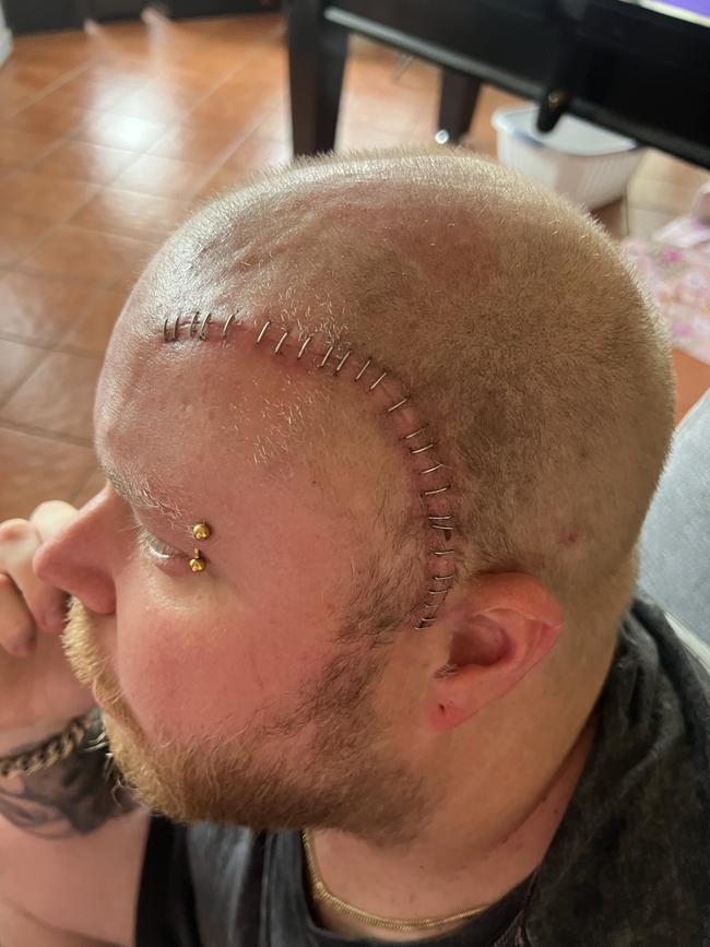 Darryl Megaw after his brain surgery. Picture: Supplied