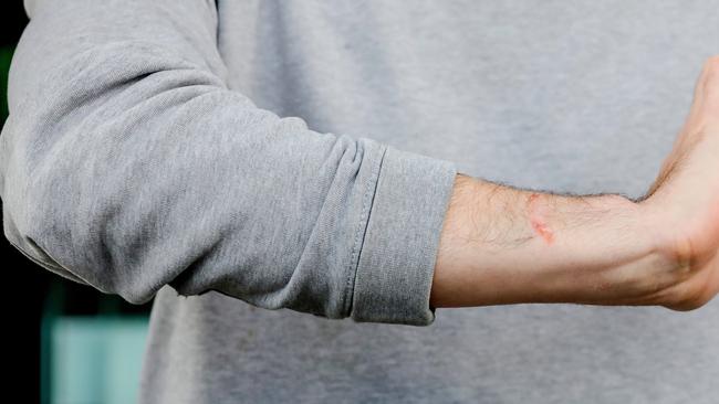 Alex Kimberley’s puncture wounds from Muratore’s dog after he tried to intervene during the attack. Picture: Tim Carrafa