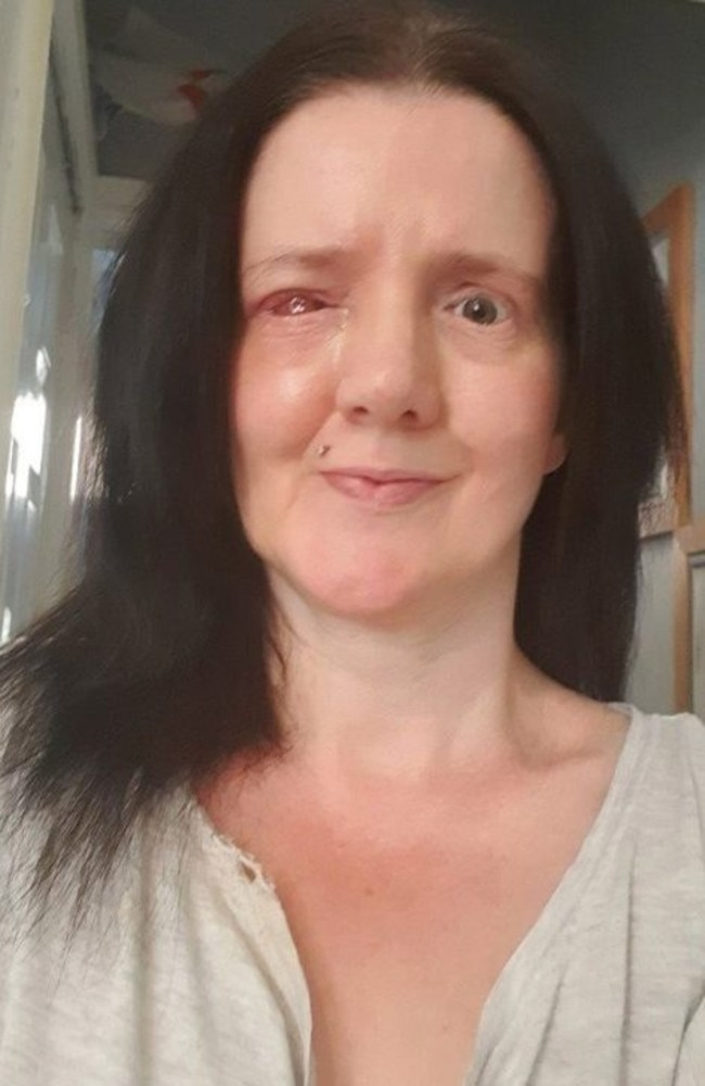 Claire says she ‘looked like an extra from The Walking Dead’ after her eyeball popped Picture: SWNS/Mega