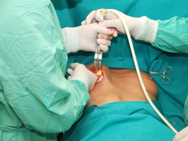 Women affected by a rare cancer linked to breast implants are in talks to launch a possible class action. Picture: Getty Images