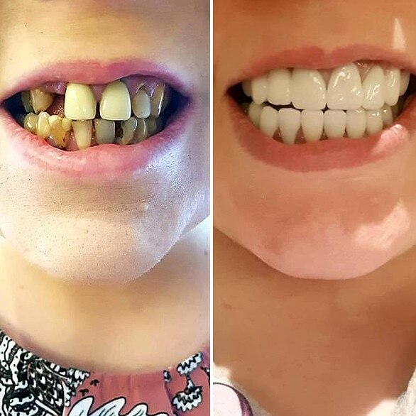 Australian woman Kate from Perth went to Seminyak Bali for a “whole mouth reconstruction”.