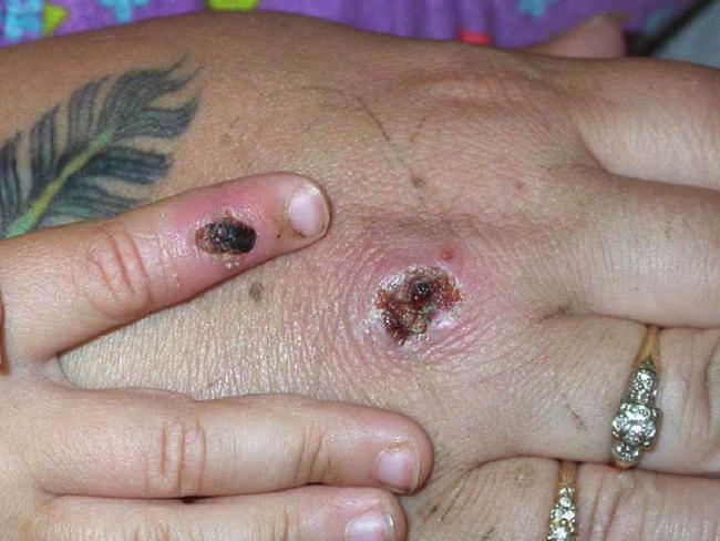 Moneypox symptoms include skin lesions. Picture: CDC/Getty Images.